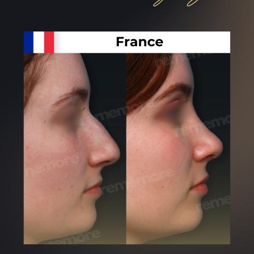 Perfiloplastia Foto antes/después